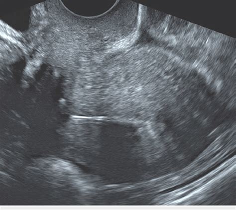 Transvaginal ultrasound showing an anteverted uterus with the... | Download Scientific Diagram