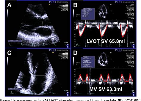 Figure 1 from Automated quantification of mitral inflow and aortic outflow stroke volumes by ...