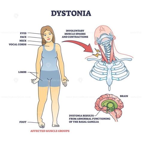 Dystonia disorder as abnormal muscle spasms and contractions outline diagram – VectorMine