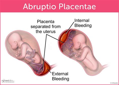 Abruptio Placentae Nursing Care & Management