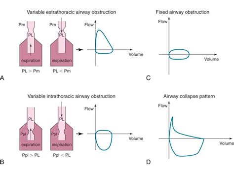 Flow Volume Loops in Spirometry - Pulmonology.weebly.com