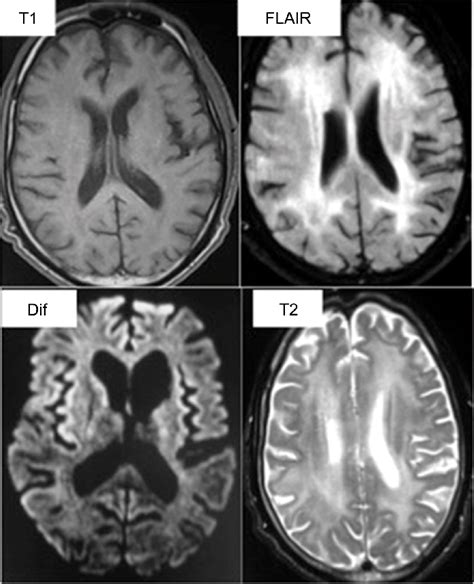 HIV encephalitis. Diffuse range of FLAIR hypersignal and T2 of... | Download High-Quality ...