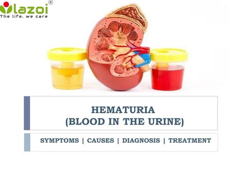 PPT - Hematuria (Blood in the urine): Symptoms, causes, diagnosis and treatment PowerPoint ...