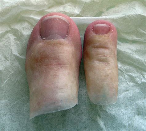 Toe Prosthesis | Milwaukee — Life-like Prosthetics