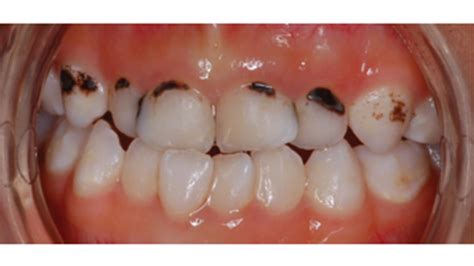 Pathways for the Management of Early Childhood Caries