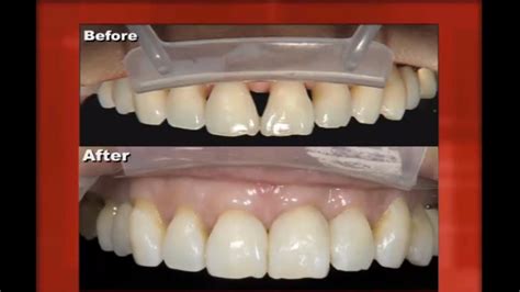 13++ Composite Veneers Procedure at Demax4 | Logdener