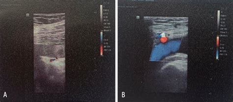 A, B Primary ultrasonography indicated the possibility of deep venous ...