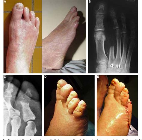 Figure 7 from Diabetic foot: the orthopedic surgery angle. | Semantic Scholar