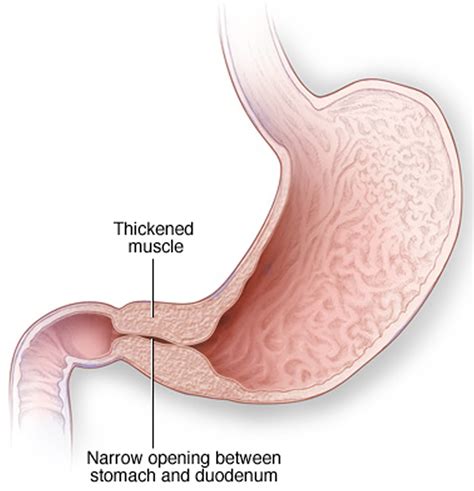 Pyloric Stenosis - Causes, Symptoms, Complications, Treatment