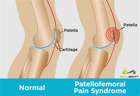 The Patella Is an Example of a