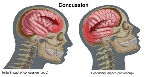 Province to focus on safer sports opportunities for kids – attention will be on concussions ...