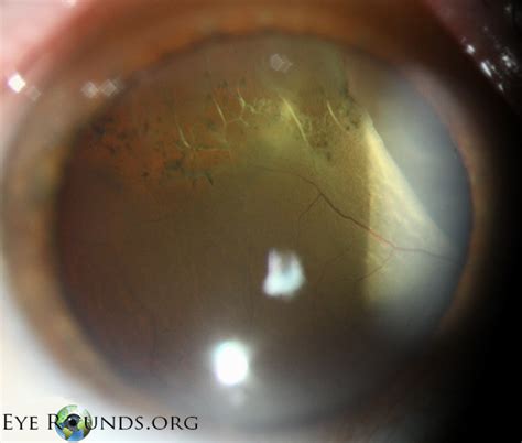 Atlas Entry - Lattice Degeneration of peripheral retina