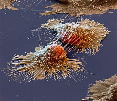 The Large Picture Blog: Cancer Under The Microscope