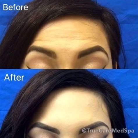 Eyebrow Lift Using Botox » Eyelid Surgery: Cost, Photos, Rewiews, Q&A