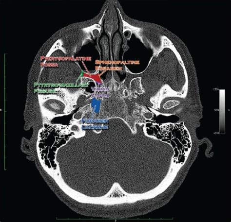 CT scan (bone window) axial section through the medial | Open-i