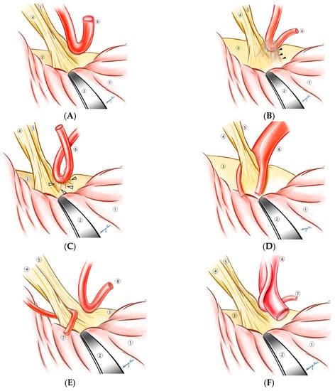 Life | Free Full-Text | Operative Findings of over 5000 Microvascular Decompression Surgeries ...