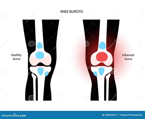 Bursitis Inflammation Concept Stock Vector - Illustration of treatment, arthritis: 220635921