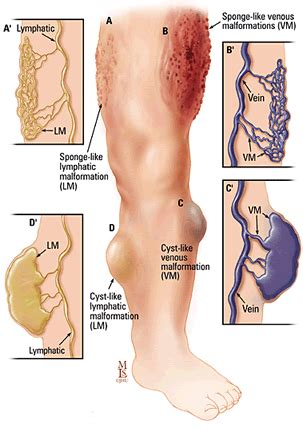 Vascular Malformations | Johns Hopkins Department of Interventional Radiology