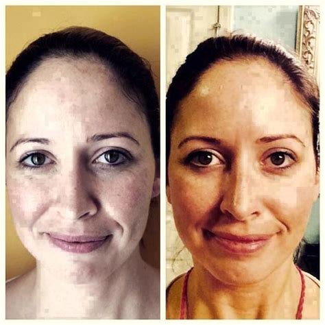 Microcurrent Facial Treatment Before And After (5) » Facelift: Info, Prices, Photos, Reviews, Q&A