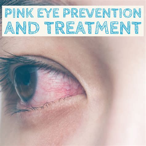 Pink Eye Prevention and Treatment — Thrifty Mommas Tips