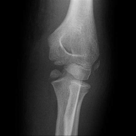 Medial Epicondyle Fracture