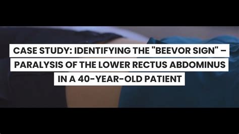 CASE STUDY: THE "BEEVOR SIGN" – PARALYSIS OF THE LOWER RECTUS ABDOMINUS IN A 40-YEAR-OLD - YouTube