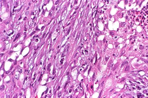 Sarcomatoid Mesothelioma | Prognosis, Treatment & Diagnosis