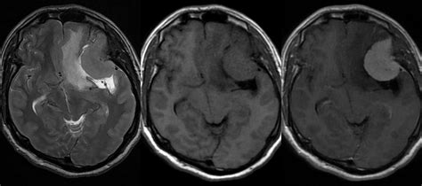 Dr Balaji Anvekar FRCR: Sphenoid wing Meningioma MRI