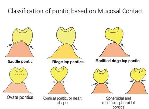 Classification of Pontics - MEDizzy