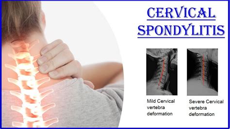Cervical Spondylosis Neck Pain