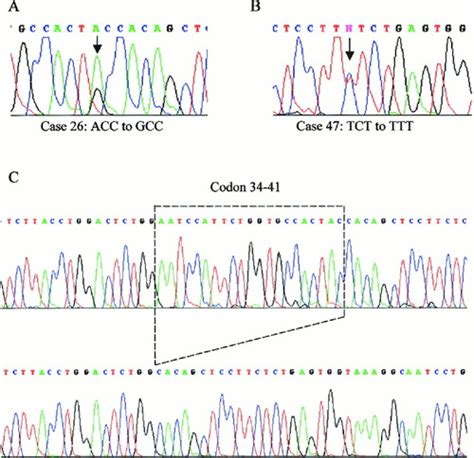 β‐catenin mutation and overexpression in hepatocellular carcinoma - Wong - 2001 - Cancer - Wiley ...