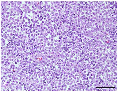 Craniopharyngioma Histology