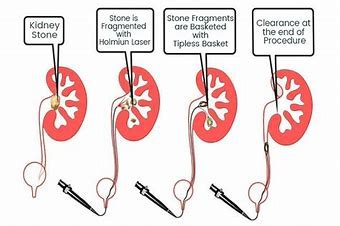 RIRS Retrograde Intrarenal Surgery: Full Form, Procedure, Video