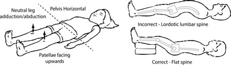 Appropriate positioning for a screening anteroposterior pelvis ...