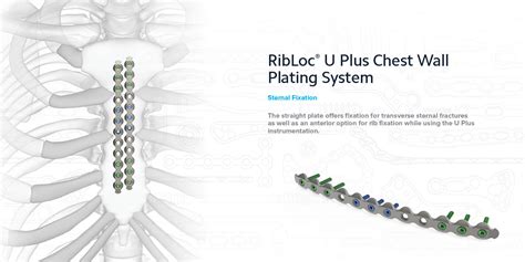 Chest Wall and Sternum Fracture Fixation | Acumed Information