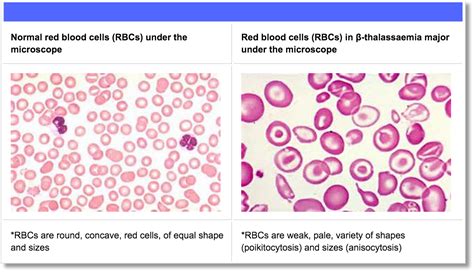 Beta Thalassaemia – TIF