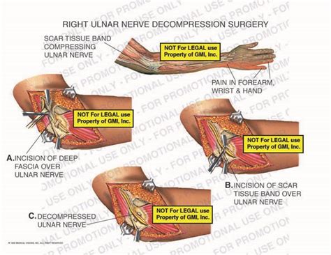 What not to do after ulnar nerve surgery? - Health Blog