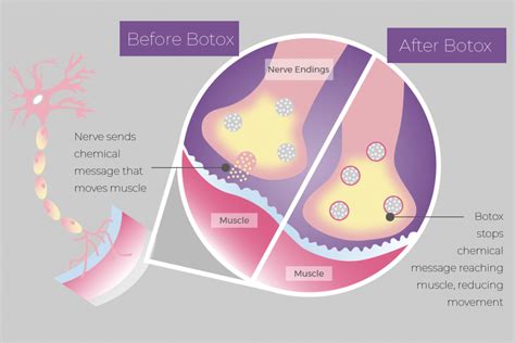 The Surprising Effect of Botox on Emotional Processing