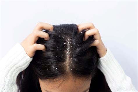 Reasons for dandruff in summer | Head and Shoulders IN