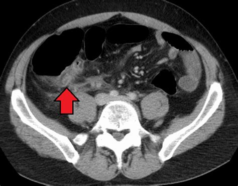 Appendicitis - almostadoctor