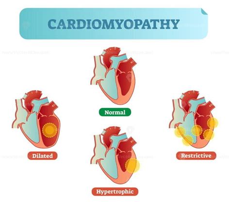 Cardiomyopathy medical disorders cross section diagram, vector illustration examples with normal ...