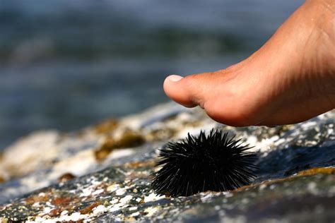 How to treat a sea urchin sting