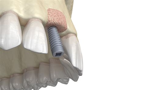 When do I Need a Bone Graft for Dental Implants? - Smile Angels of Beverly Hills