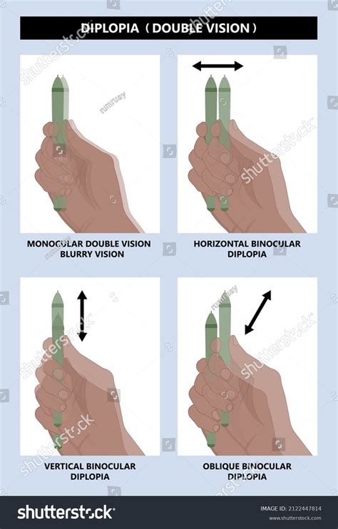 Diplopia Double Vision Test Exam Brain Stock Vector (Royalty Free ...