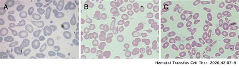 Coinheritance of beta-thalassemia minor and hereditary pyropoikilocytosis: case report ...
