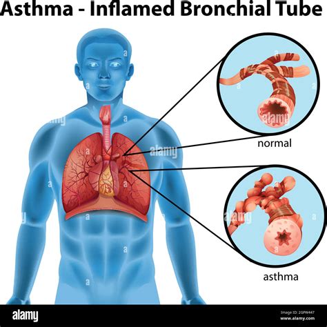 Asthma-inflamed bronchial tube Stock Vector Image & Art - Alamy