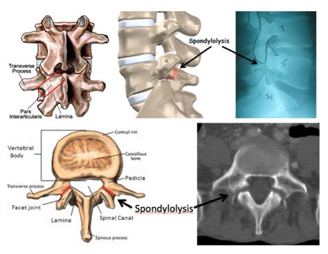 85 Amazing Define Spondylolysis Medical Terminology - insectza