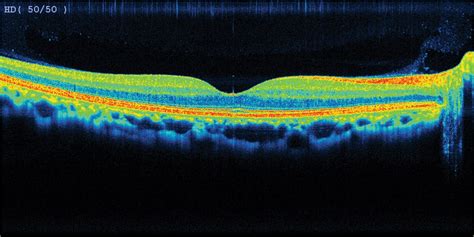 Macular Degeneration | Grace & Vision Optometrist Brisbane