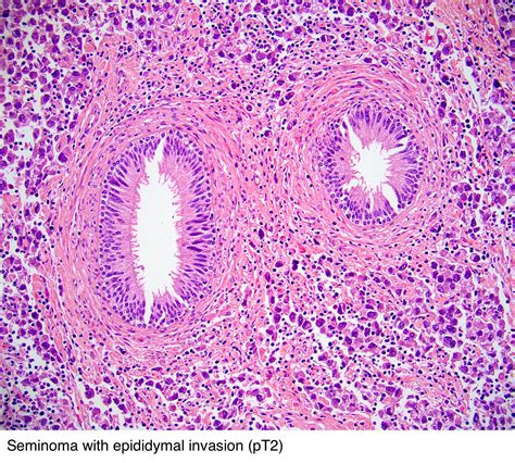 Pathology Outlines - Seminoma