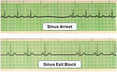 EKG Detective: Sinus arrest vs. sinus exit block